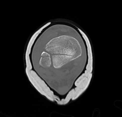 Posterior malleolus 2